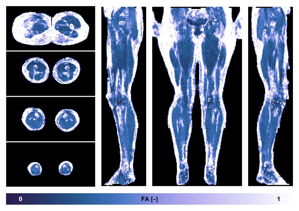 IVIM corrected whole leg muscle fractional anisotropy obtained from diffusion tensor imaging.